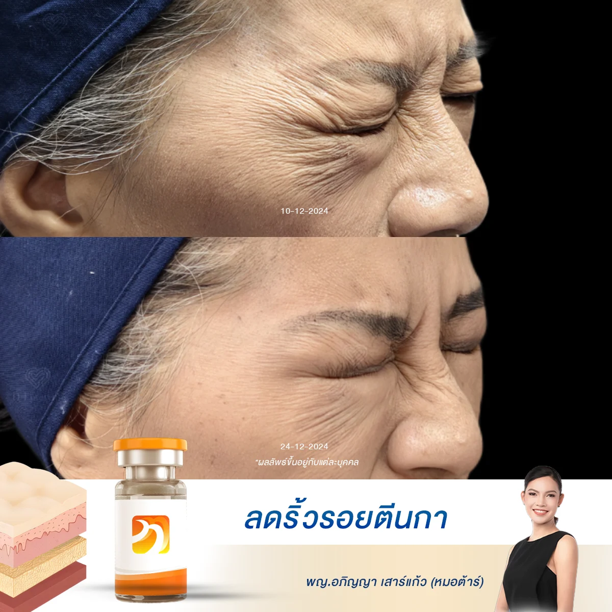 อายุ 60+ ยังไงก็หน้าใส! หมอยืนยัน โบท็อกซ์รอบนี้ผลลัพธ์เกินคาด