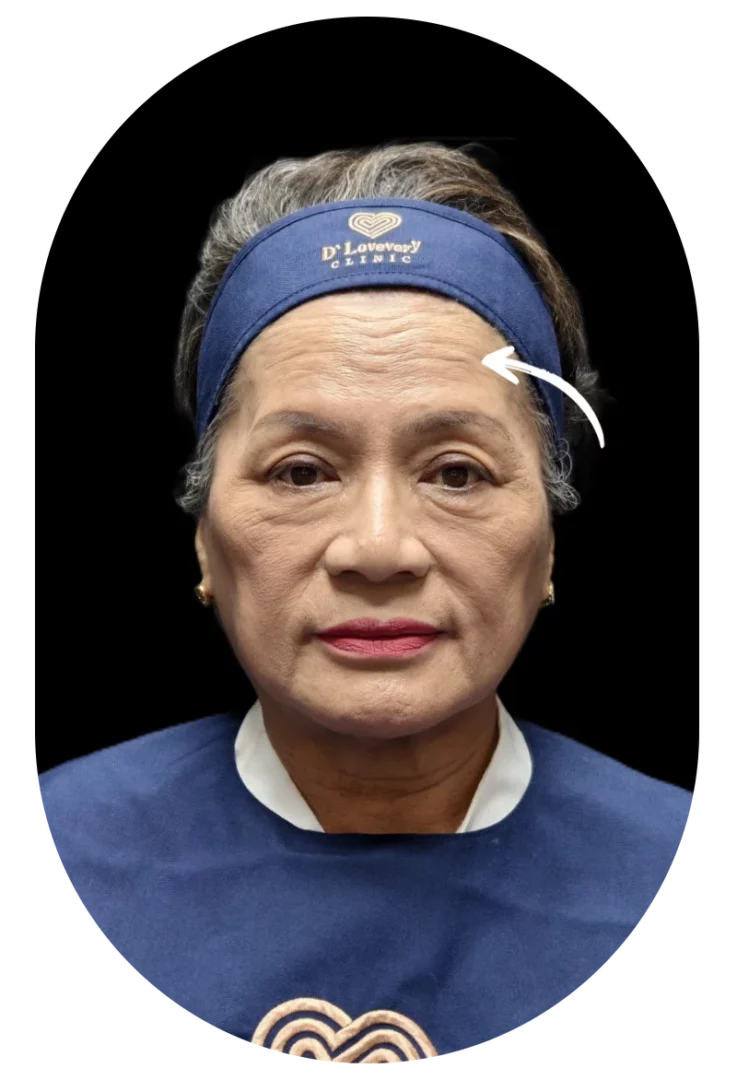 ทำไมคุณผู้หญิงวัย 60 ถึงกล้าฉีดโบท็อกซ์ครั้งแรก? รีวิวนี้มีคำตอบ