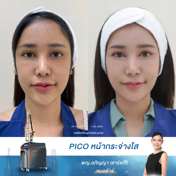 เปิดประสบการณ์ผิวกระจ่างใสด้วย Pico Laser ที่ดีเลิฟเวอรี่คลินิก