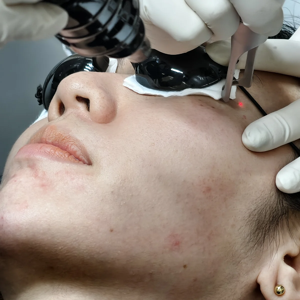 จากรอยสิวลึก เป็นผิวใสใน 1 เดือนที่ D’Lovevery Clinic