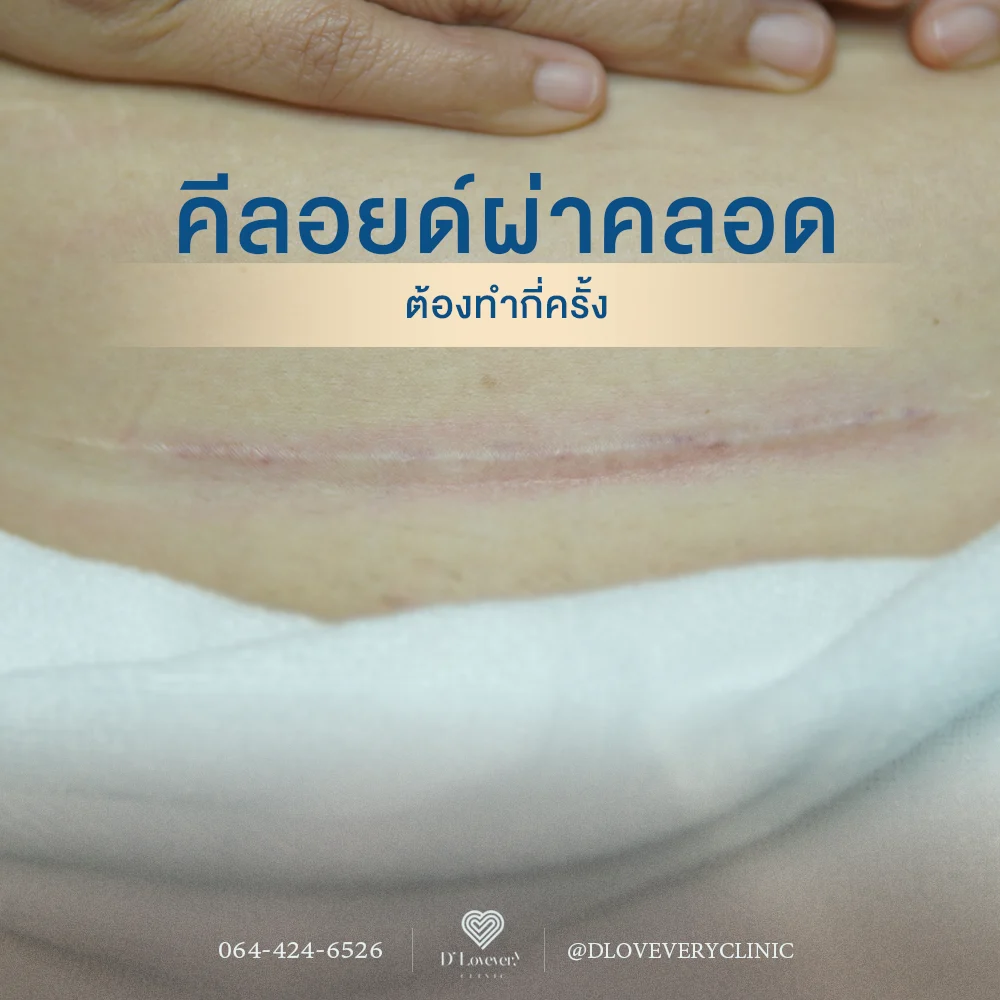 แค่ 2 ขั้นตอน…รอยแผลผ่าคลอดหายจางลง จนแฟนทัก!