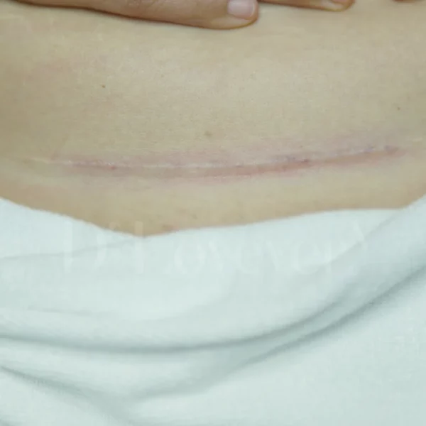 มั่นใจขึ้นจริงไหม? แชร์ประสบการณ์ลดรอยคีลอยด์จากคุณแม่ลูกอ่อน