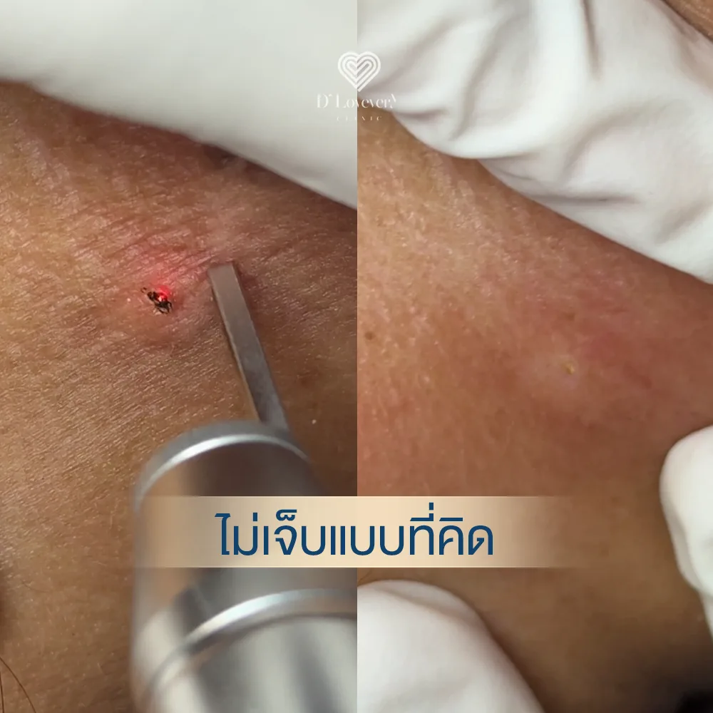 co2 laser จี้กระเนื้อ เจ็บไหม