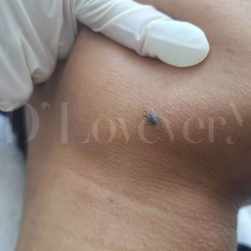 ไฝที่มีขนเกิดตรงกลาง อันตรายไหม กำจัดได้ไหม