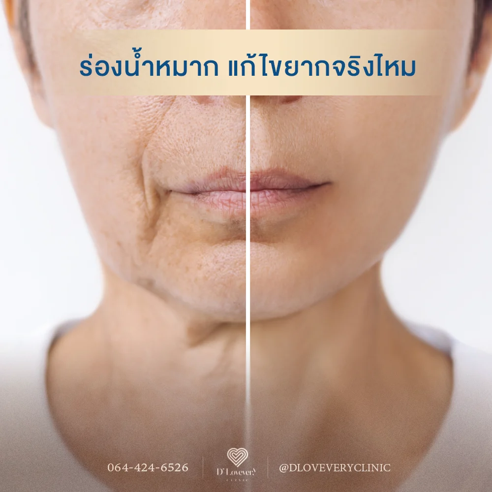 ร่องน้ำหมาก แก้ไขยากไหม ฉีดฟิลเลอร์ รีวิว