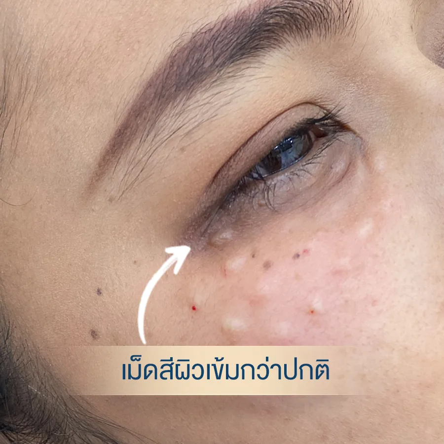 ใต้ตาคล้ำ รอบดวงตาคล้ำ เม็ดสีเข้มกว่าปกติ รักษายังไง ราคาเท่าไหร่ d prompt glow