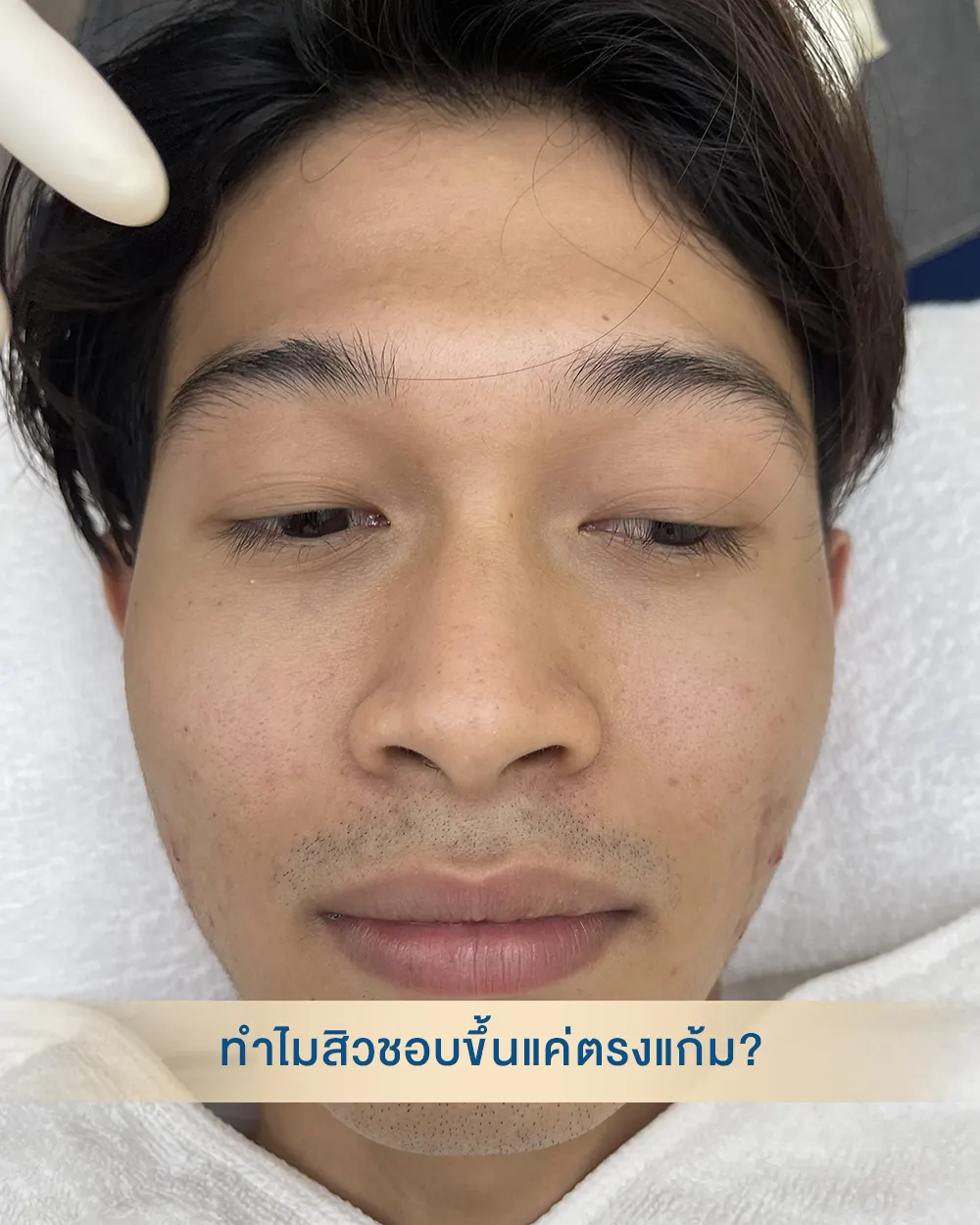 แค่ 4 สัปดาห์ เปลี่ยนหน้าสิวเป็นหน้าใส ทำได้อย่างไร