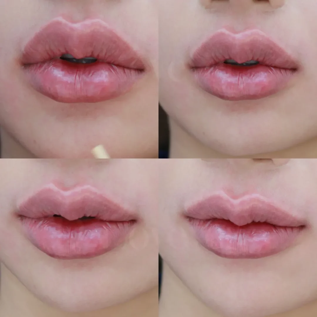 แก้ปัญหาปากบาง ไม่ได้รูป ด้วยฟิลเลอร์แค่ 1 CC จะเปลี่ยนไปได้ขนาดไหน?