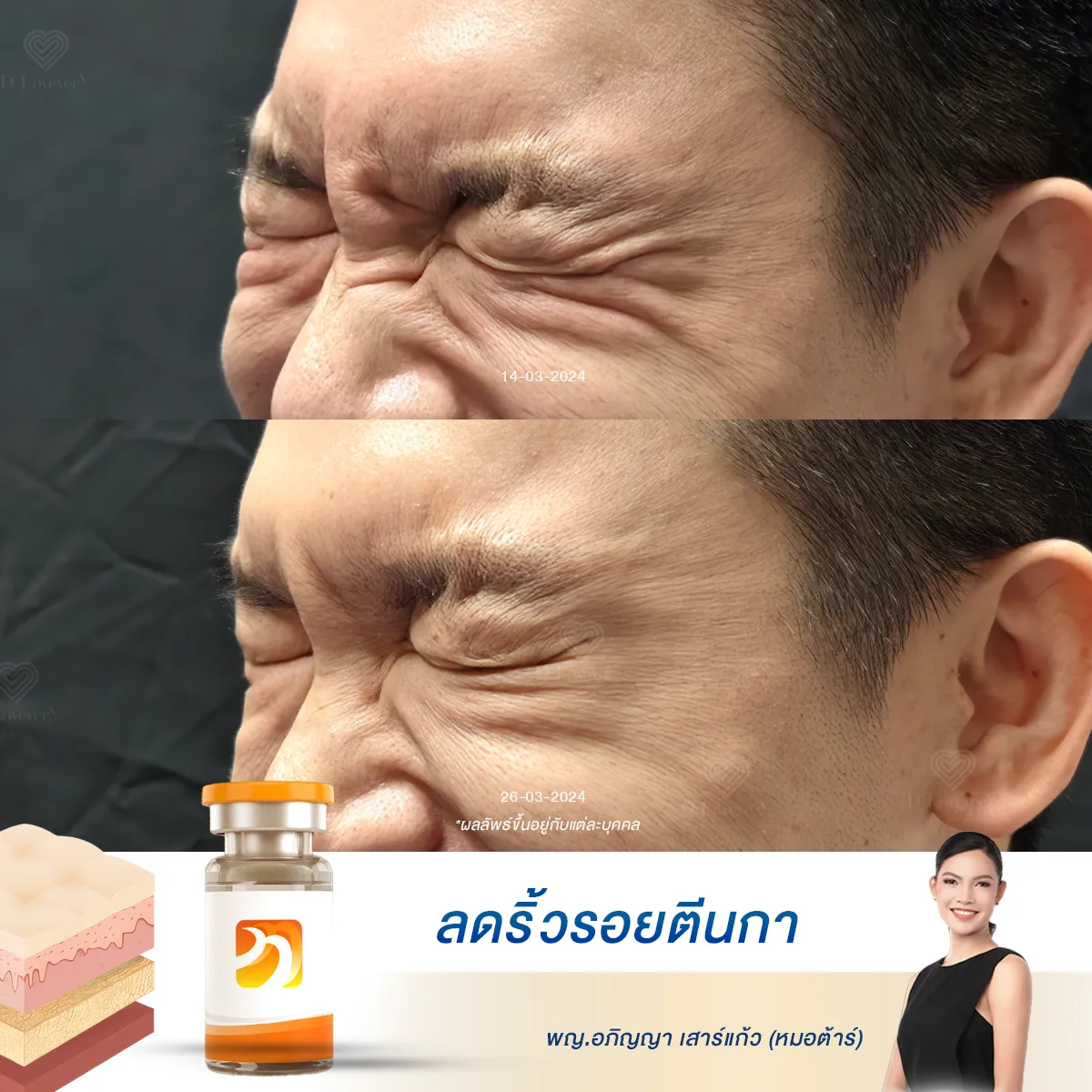 รีวิวจริงจากผู้ชายที่ต้องพบปะผู้คนทุกวัน ริ้วรอยหมดไปอย่างเห็นได้ชัด