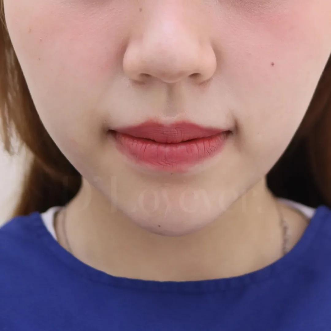 ทำไมสาวๆ ถึงเลือกฟิลเลอร์ปากที่คลินิกเรา