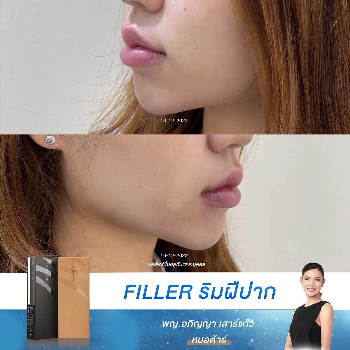 ควบคุมทรงปากและปริมาณได้ง่าย คุณหมอและลูกค้าสามารถสังเกตรูปทรงปากระหว่างทำได้เลย หากมีจุดที่อยากปรับเพิ่มก็เติมได้ทีละนิด ๆ ไม่ต้องกลัวเกินพอดี