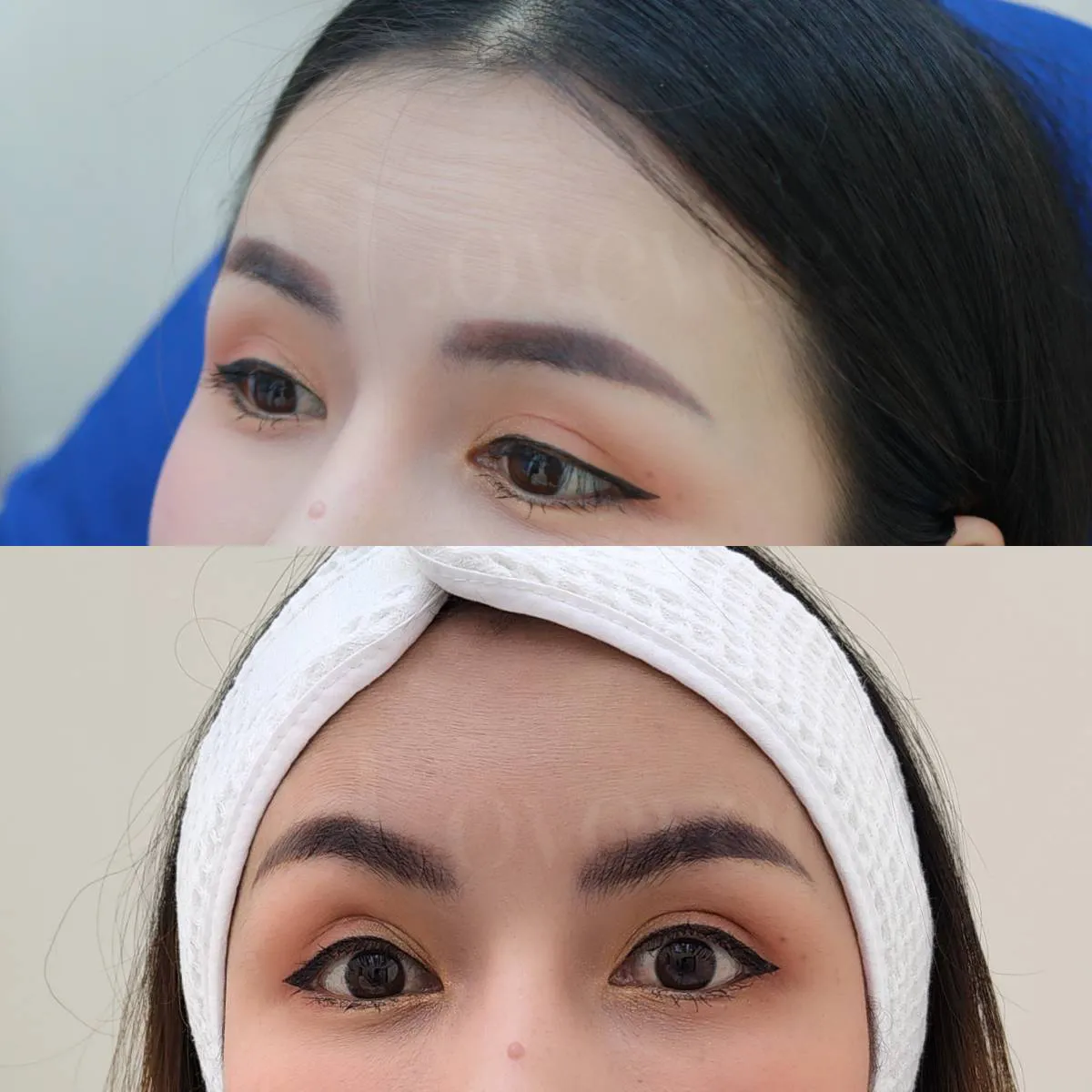 ปรับกรามและริ้วรอยทั่วหน้า งบชัด ผลลัพธ์ 4 ถึง 6 เดือน