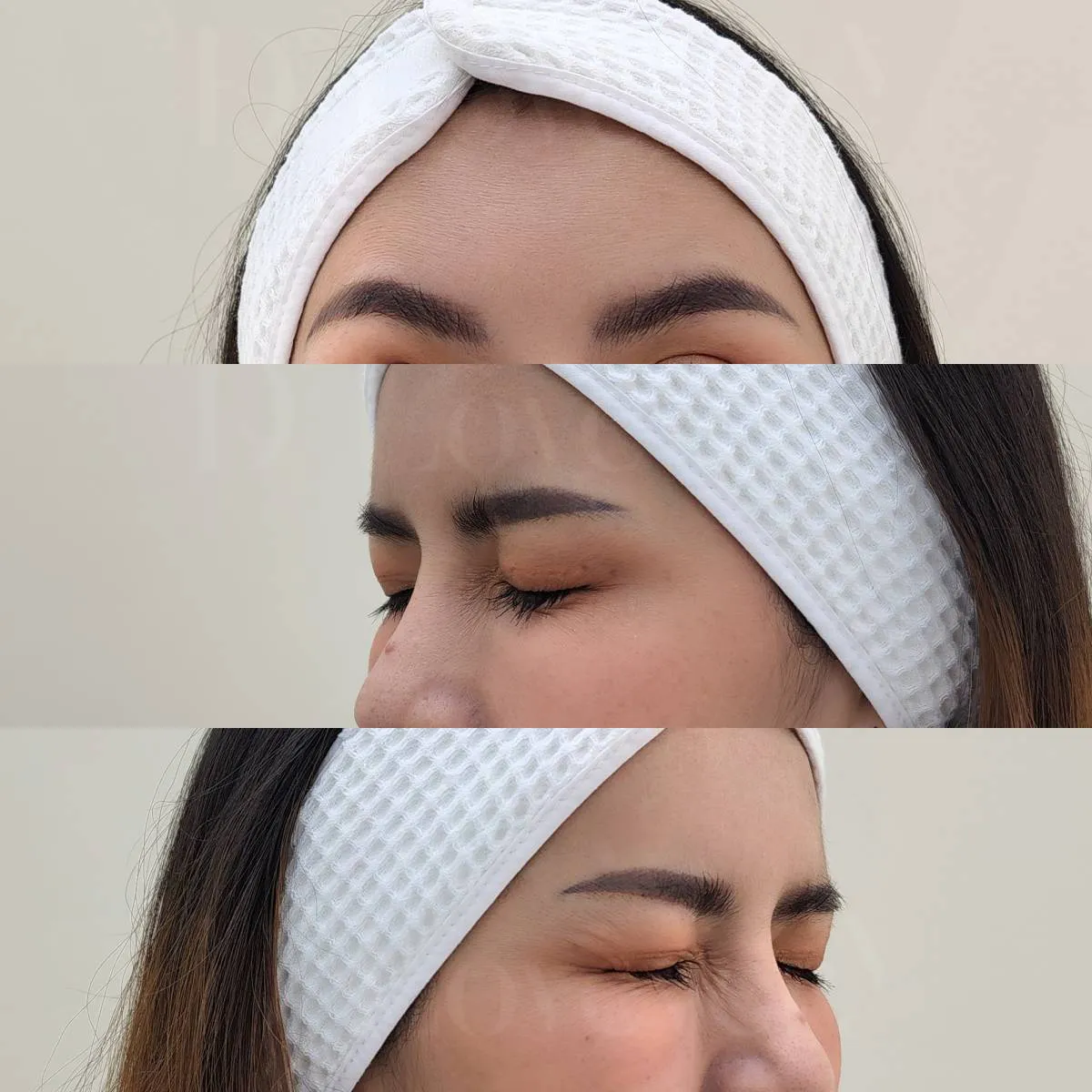 หน้าเรียวธรรมชาติด้วย Botulinum Toxin เคสจริงก่อนหลัง