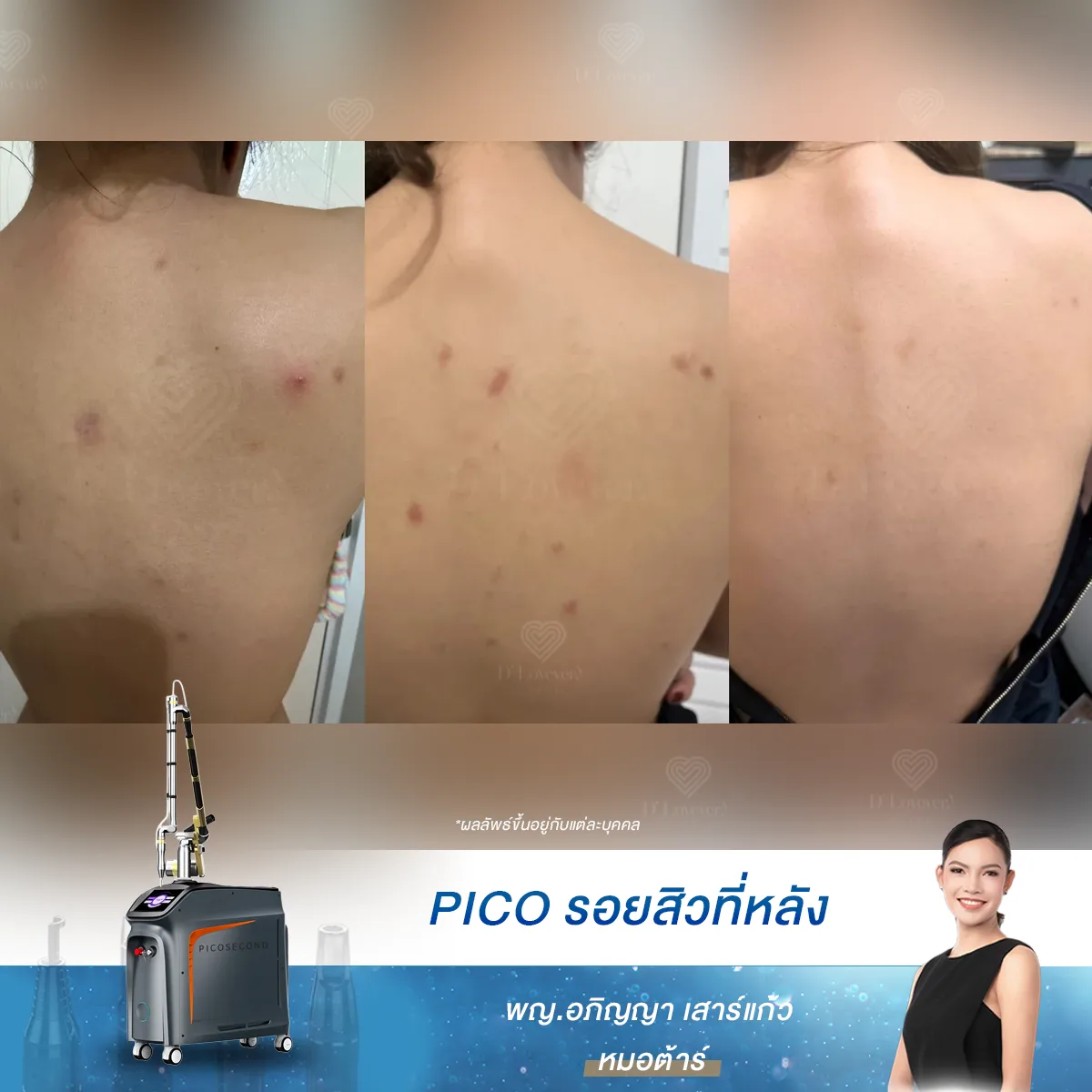 pico laser ลบรอยสิว รอยสิวที่หลัง ทำกี่ครั้ง