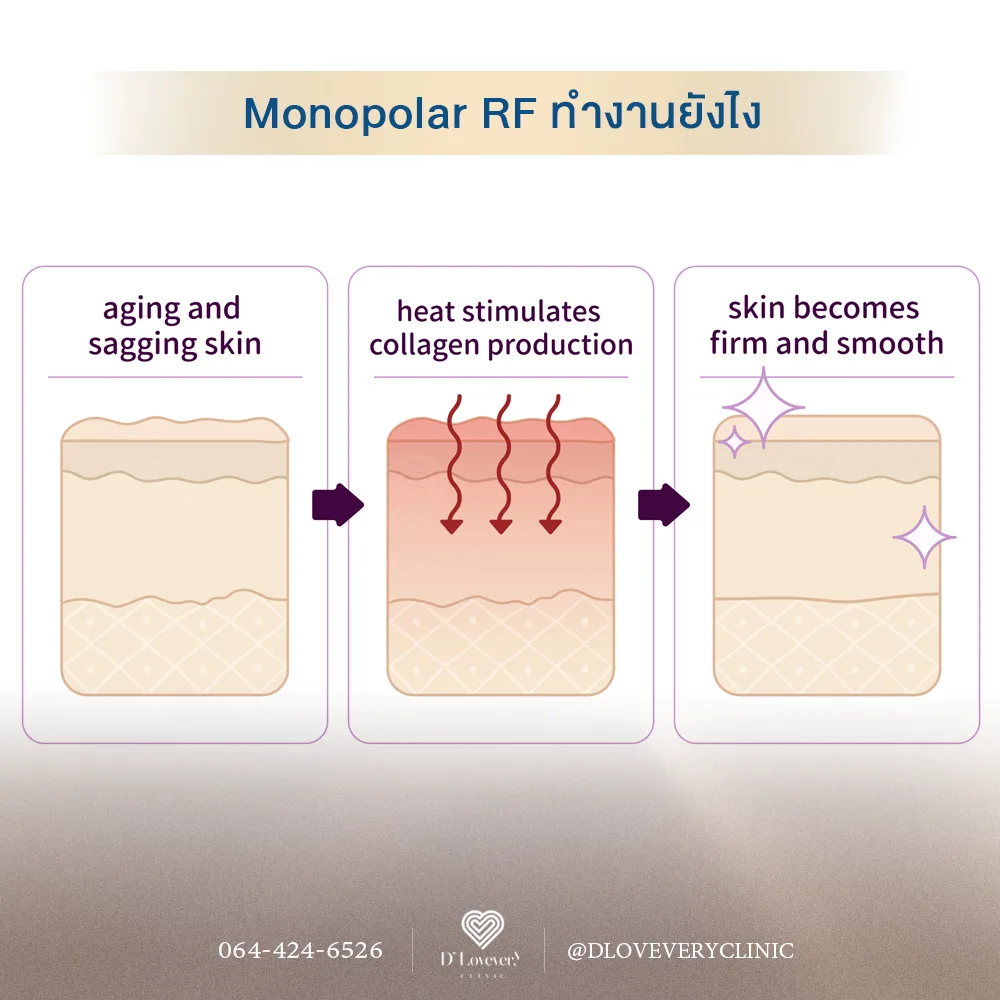 ในทางการแพทย์ปัจจุบัน การทำ Monopolar RF และ HIFU ร่วมกัน ถือเป็น Gold Standard หรือมาตรฐานที่ดีที่สุดสำหรับการยกกระชับใบหน้าโดยไม่ต้องผ่าตัดเลยค่ะ