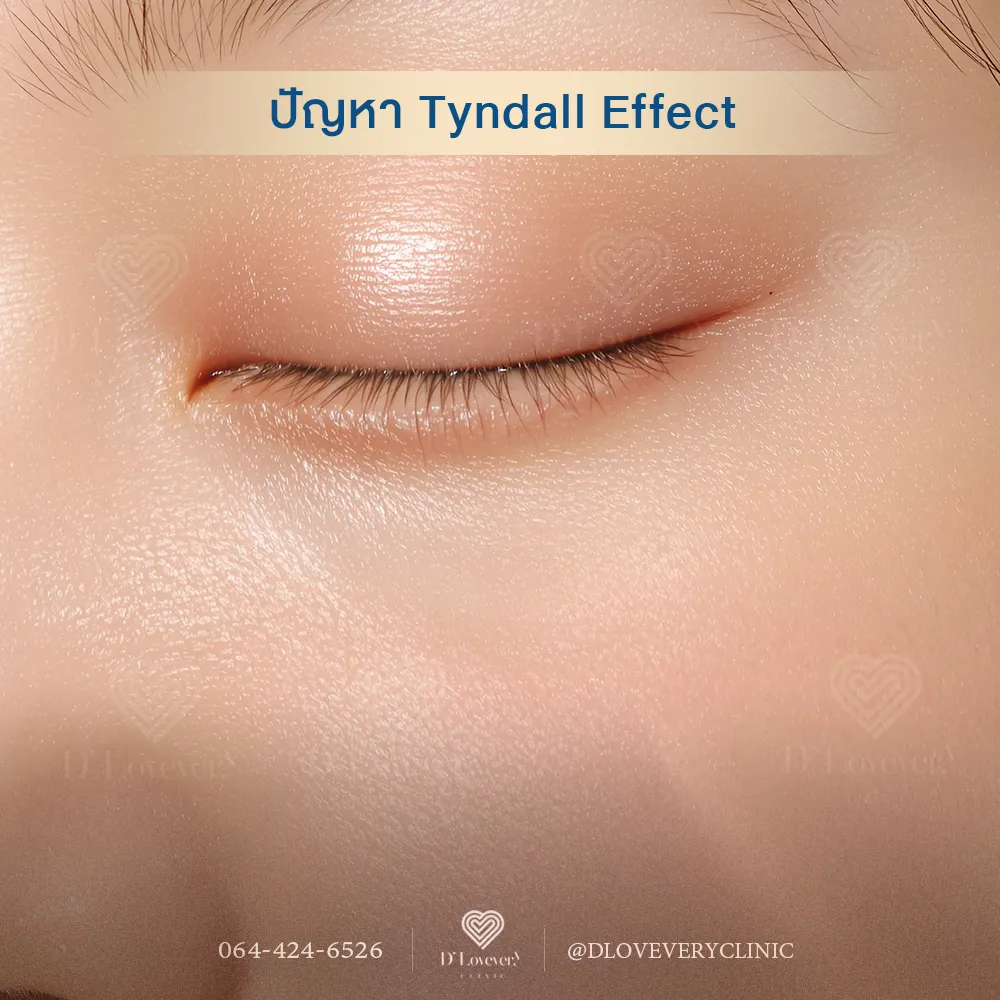 Tyndall Effect คืออะไร แก้ไขราคาเท่าไหร่