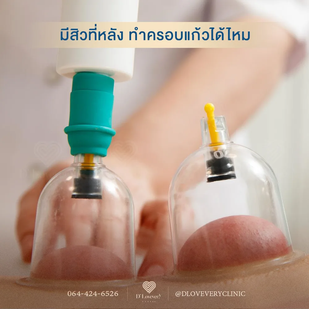 รักษาสิวที่หลังอยู่แต่อยากทำครอบแก้ว ทำได้ไหม? แพทย์ผู้เชี่ยวชาญอธิบายข้อดี-ข้อเสีย ความเสี่ยงที่อาจทำให้สิวเห่อและอักเสบหนักกว่าเดิม พร้อมคำแนะนำที่ถูกต้อง