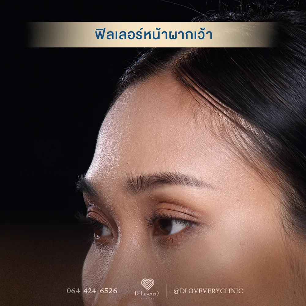หน้าผากเว้า เป็นคลื่น ไม่เรียบ มีร่องลึกตรงหัวคิ้ว แก้ไขด้วยฟิลเลอร์ได้ไหม ราคาเท่าไหร่