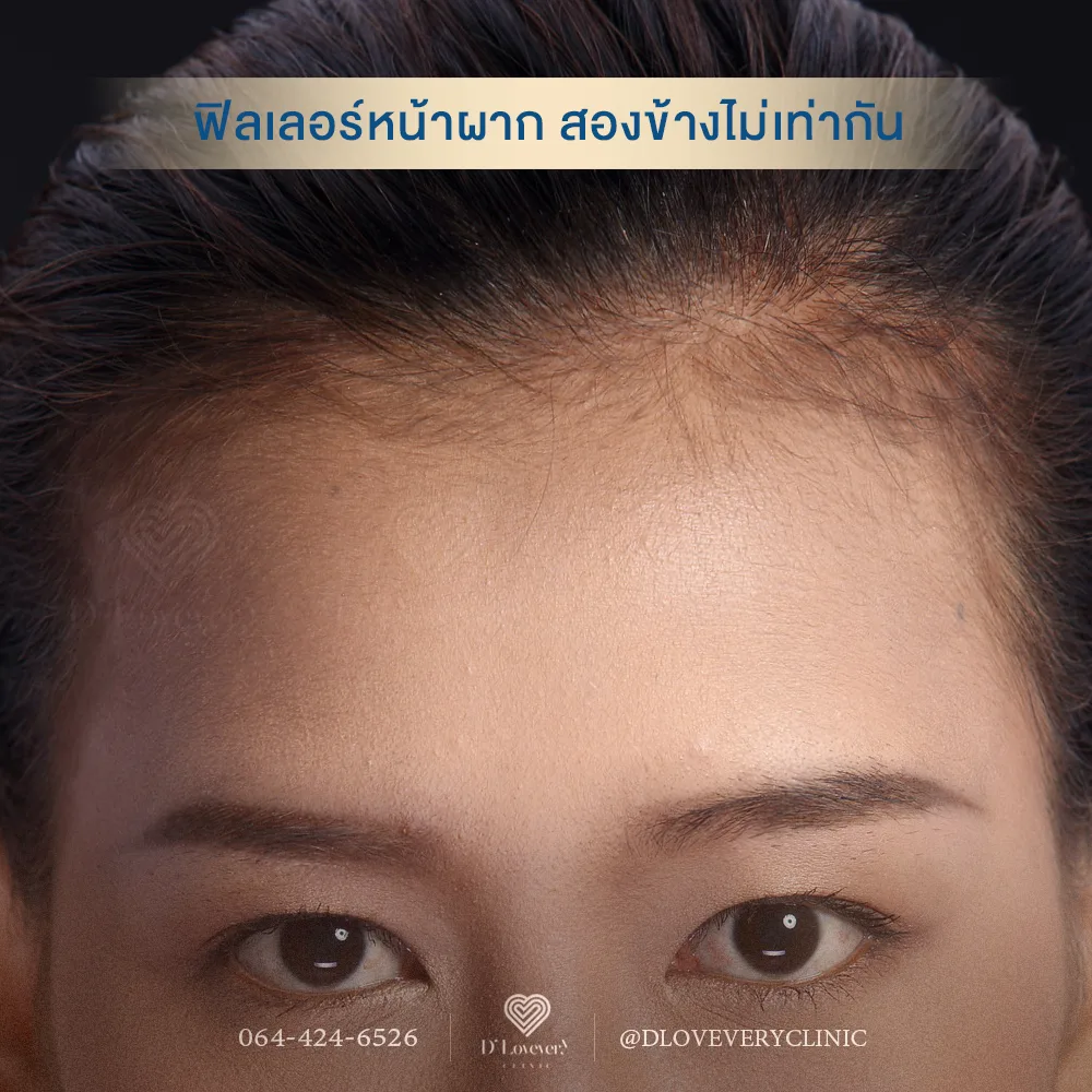 ฟิลเลอร์หน้าผาก ไม่เท่ากัน ยุบตัวไม่เท่ากัน ไม่เรียบเนียน แก้ไขได้ ราคาเท่าไหร่