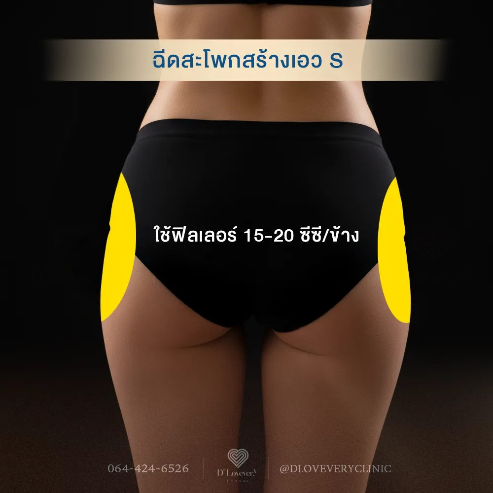 ฉีดฟิลเลอร์ ทำเอว S ใช้ฟิลเลอร์กี่ซีซี ราคาเท่าไหร่