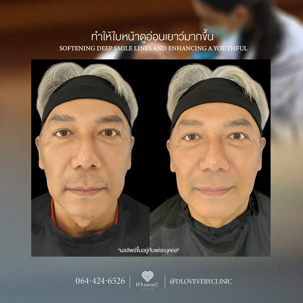 smile lines filler dlovevery clinic 1
