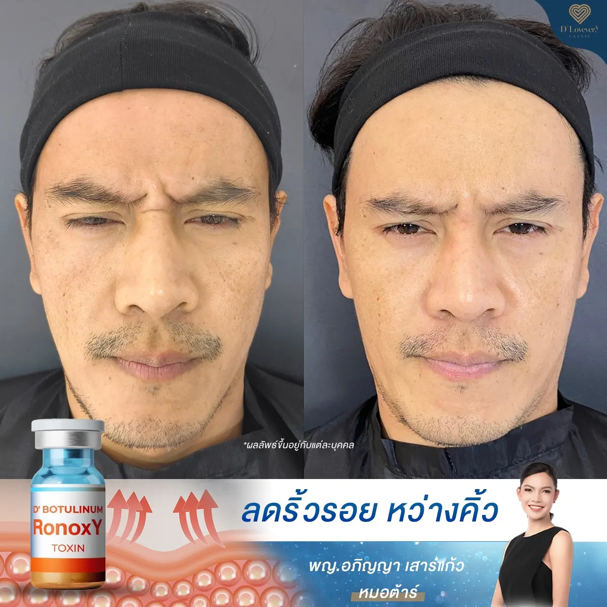 รีวิวโบท็อกซ์ริ้วรอยหว่างคิ้ว ขมวดคิ้ว