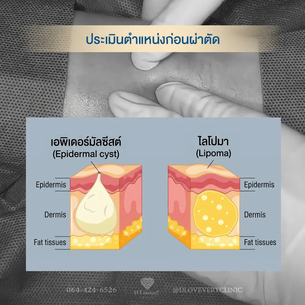Epidermal-cyst-vs-lipoma-dlovevery-clinic-2