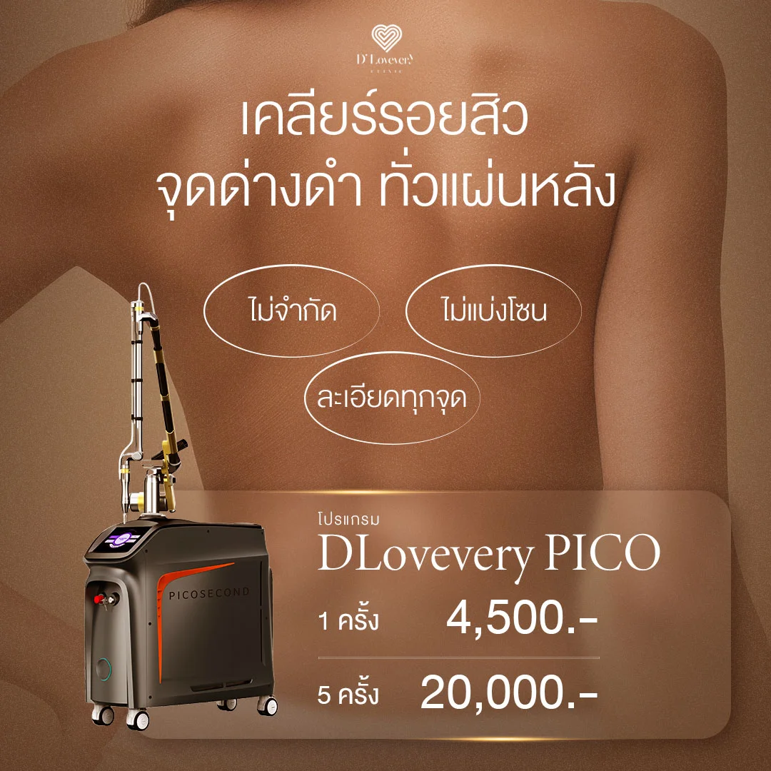 รอยสิวที่หลังกวนใจ? โปรสุดคุ้ม Pico Laser เริ่มต้น 4,500.- (5 ครั้ง 20,000.-)  หลังเนียนใส ไร้รอยสิว เห็นผลจริง