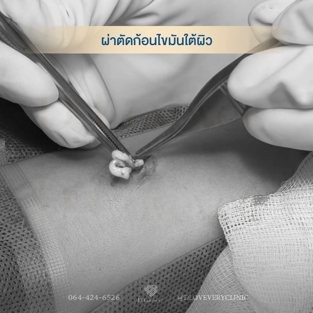ผ่าไขมันใต้ผิวหนัง ซีสต์ ก้อนไขมันมาจากไหน อันตรายไหม ราคาเท่าไหร่ คำถามที่พบบ่อย
