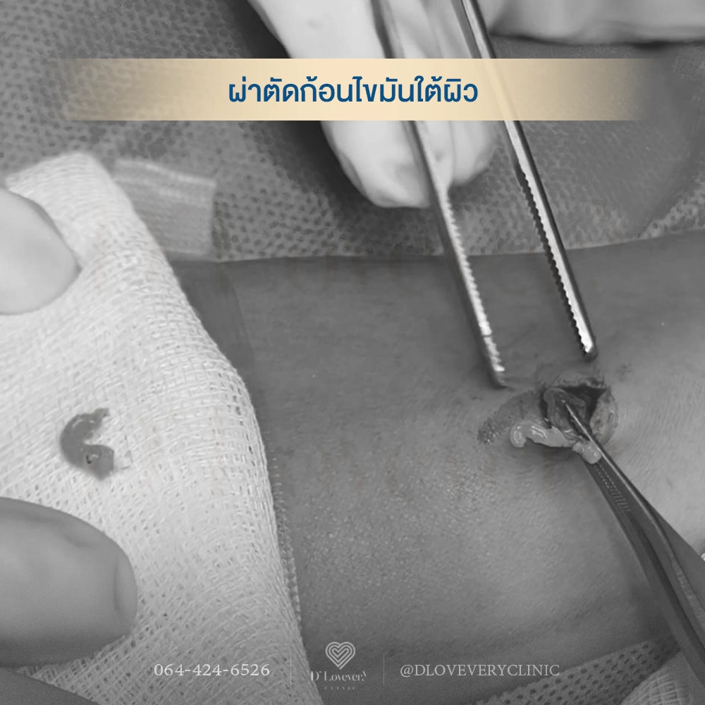 ผ่าไขมันใต้ผิวหนัง ซีสต์ ก้อนไขมันมาจากไหน อันตรายไหม ราคาเท่าไหร่ คำถามที่พบบ่อย
