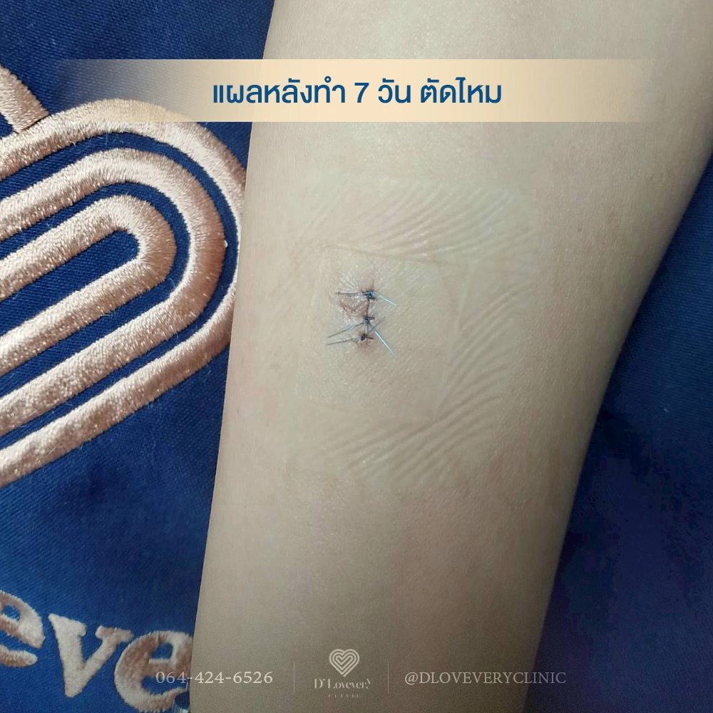 ผ่าไขมันใต้ผิวหนัง ซีสต์ ก้อนไขมันมาจากไหน อันตรายไหม ราคาเท่าไหร่ คำถามที่พบบ่อย วันตัดไหม