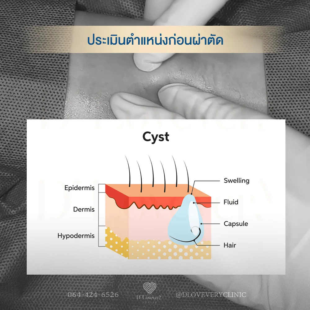 ตำแหน่งไขมันใต้ชั้นผิว ประเมินโดยแพทย์ก่อนผ่าตัด