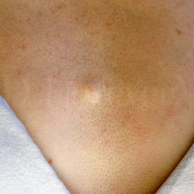 ซีสต์ไขมันใต้ผิวหนัง (Sebaceous cyst)