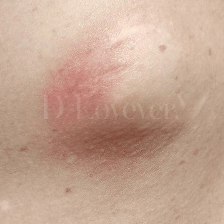 ซีสต์ไขมันใต้ผิวหนัง (Sebaceous cyst)