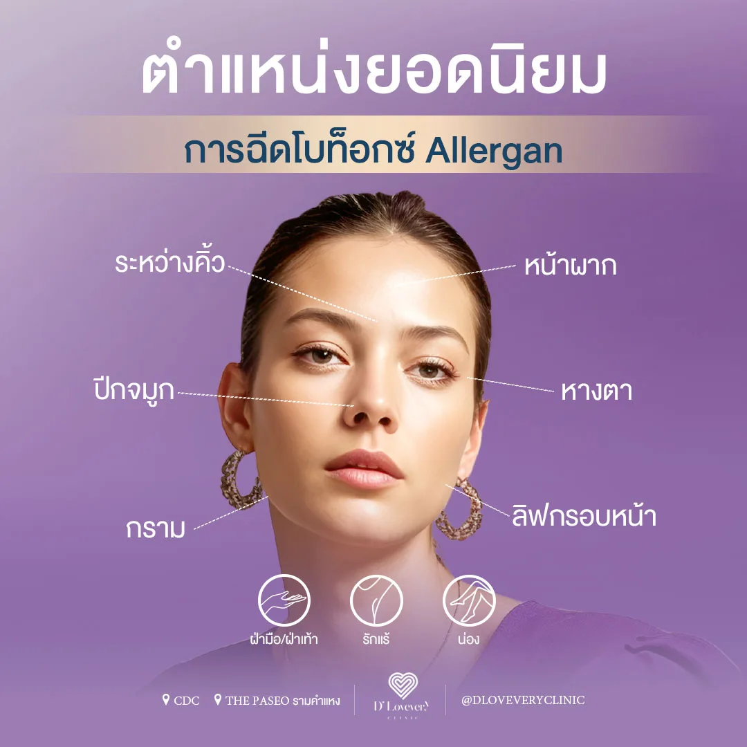 ฉีด Botox ตำแหน่งไหน ตำแหน่งยอดนิยม Allergan D' Lovevery Clinic