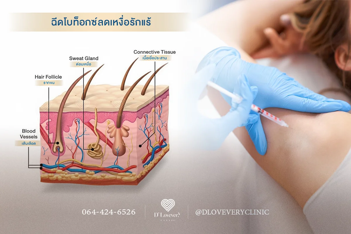 โปรแกรมฉีดโบท็อกรักแร้ ลดเหงื่อ ลดกลิ่นกาย เพิ่มความมั่นใจ