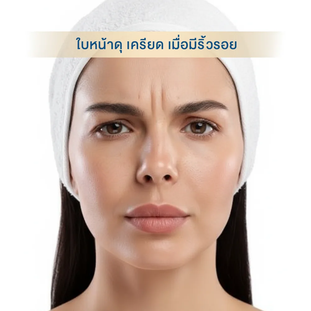 ฉีดโบลดริ้วรอยระหว่างคิ้ว คืออะไร กี่วันเห็นผล อันตรายไหม หน้าดูดุ เมื่อมีรีิ้วรอย