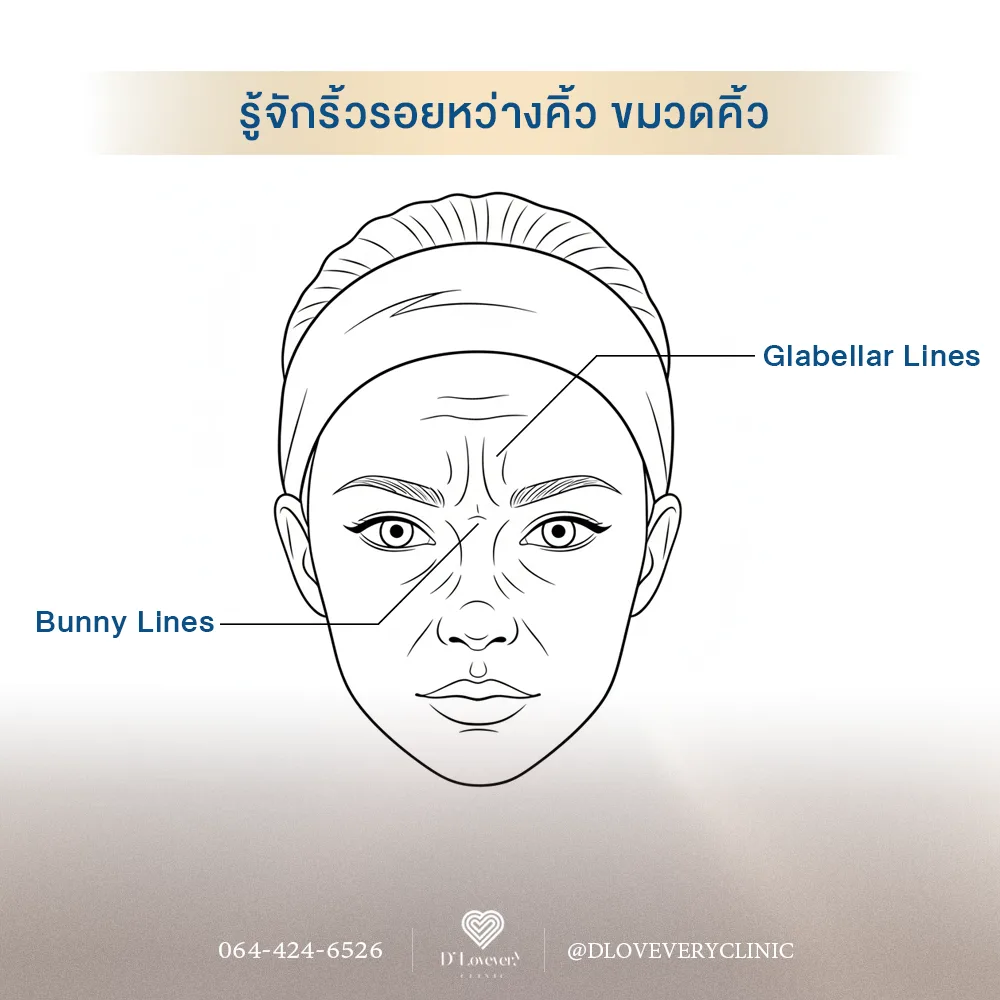 ตารางเปรียบเทียบโบท็อกซ์โบท็อกซ์สันจมูก (Bunny Lines) โบท็อกซ์ระหว่างคิ้ว (Glabellar Lines)	
