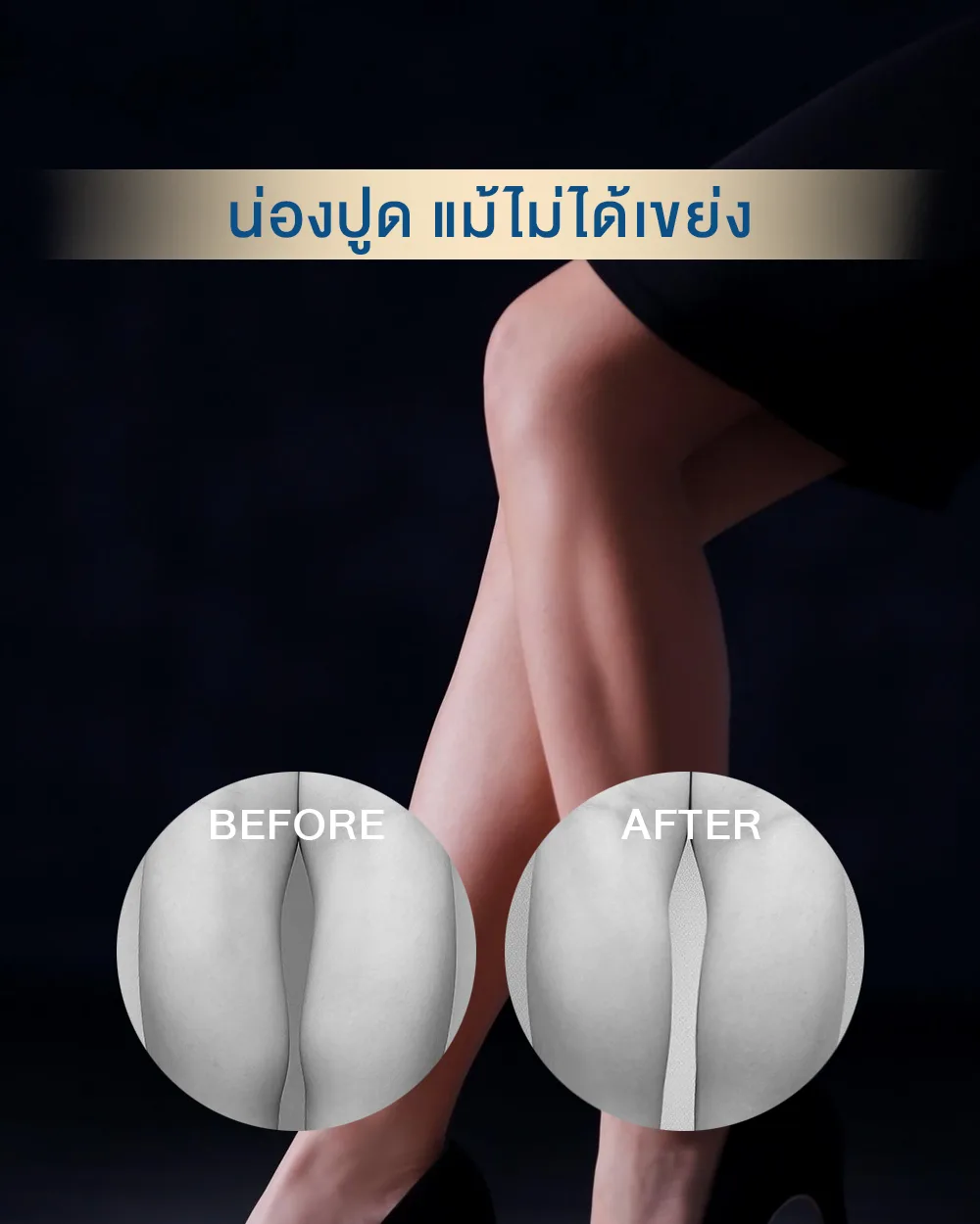 โบท็อกลดน่อง คือการใช้สาร Botulinum Toxin ฉีดเข้าไปที่กล้ามเนื้อน่อง (Gastrocnemius) ซึ่งเป็นสาเหตุหลักของน่องโต น่องปูดในหลายๆ คน สารโบท็อกจะออกฤทธิ์ทำให้กล้ามเนื้อบริเวณดังกล่าวทำงานลดลงชั่วคราว เมื่อกล้ามเนื้อไม่ได้ถูกใช้งานหนักเหมือนเดิม ก็จะมีขนาดเล็กลง ส่งผลให้น่องดูเรียวสวยและได้รูปทรงที่สมส่วนมากขึ้น เป็นหัตถการที่ปลอดภัยและเห็นผลชัดเจนโดยไม่ต้องผ่าตัด