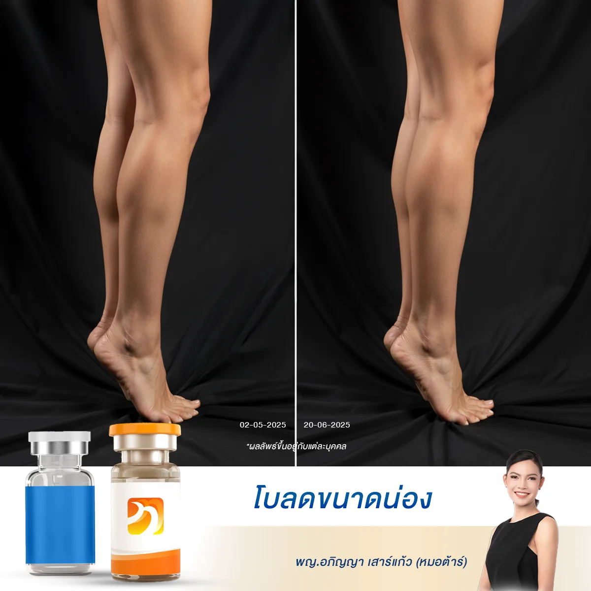 รีวิวฉีดโบท็อกซ์ลดน่อง น่องใหญ่ น่องปูด อยากขาเรียวเล็ก