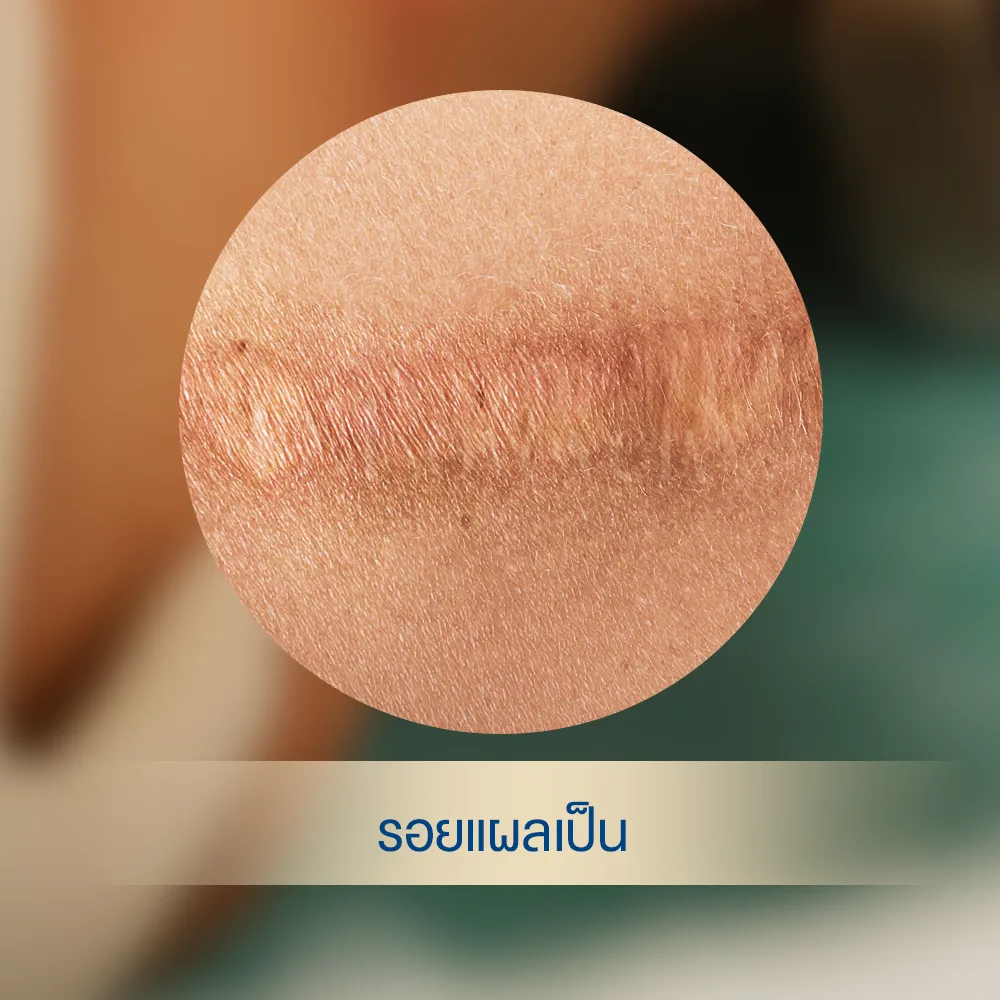รอยแผลเป็นทั่วไป (Hypertrophic Scar)