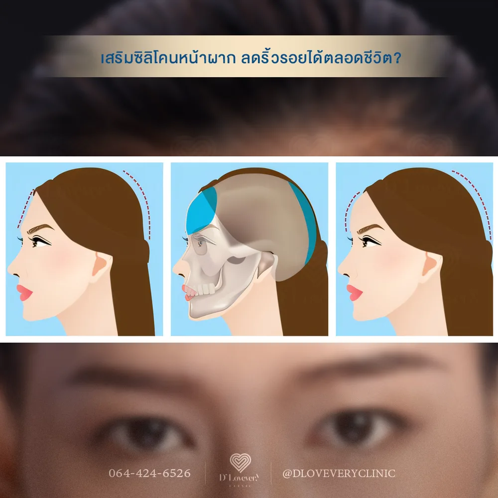 เสริมหน้าผาก จะลดริ้วรอยได้ตลอดชีวิตไหม