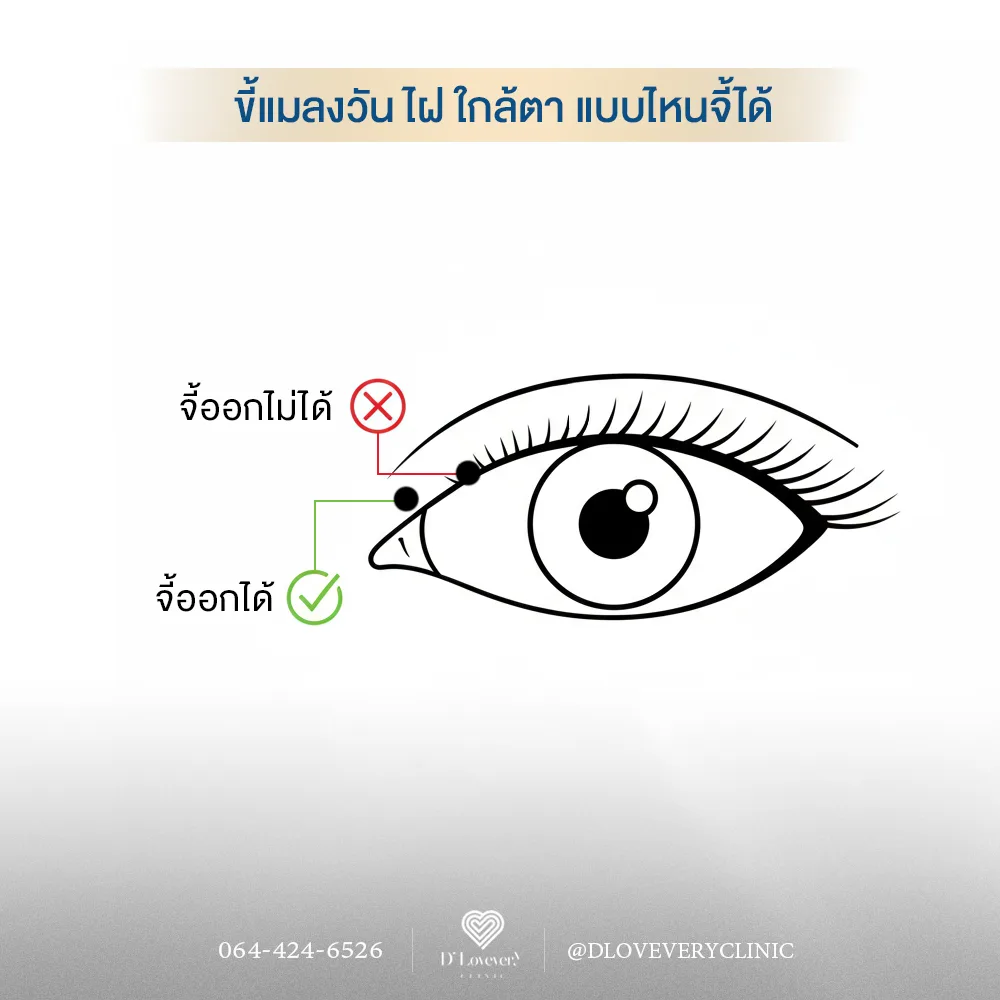 ขี้แมลงวันใกล้ตา หมอรับจี้ไหมคะ