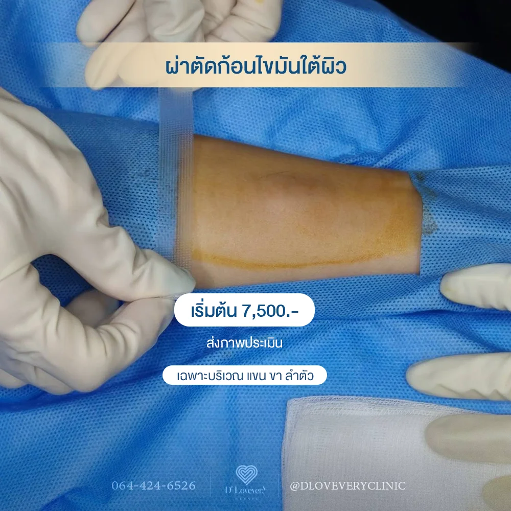 ทำไม "ซีสต์" ถึงกลับมาที่เดิม? (ทั้งที่ผ่าไปแล้ว)