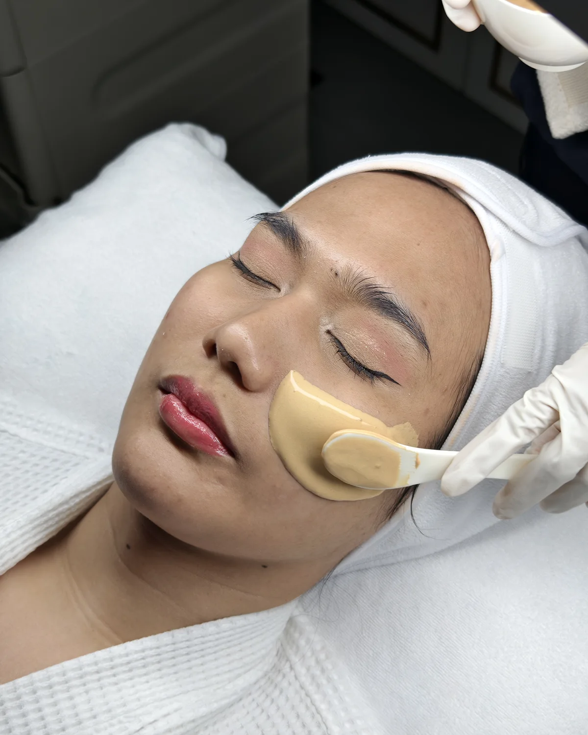 น้องยุรีทำ D’ Aura Bright ทุกอาทิตย์ ทำ Pico Laser ทุกเดือน รอยสิวก็จะจางลงแบบนี้แหล่ะ