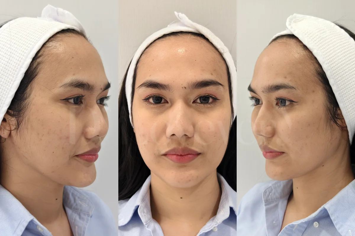 รอยสิวหายจริงไหม? รีวิว Dlovevery Pico Laser รามคำแหง ฉบับคนขี้กลัว