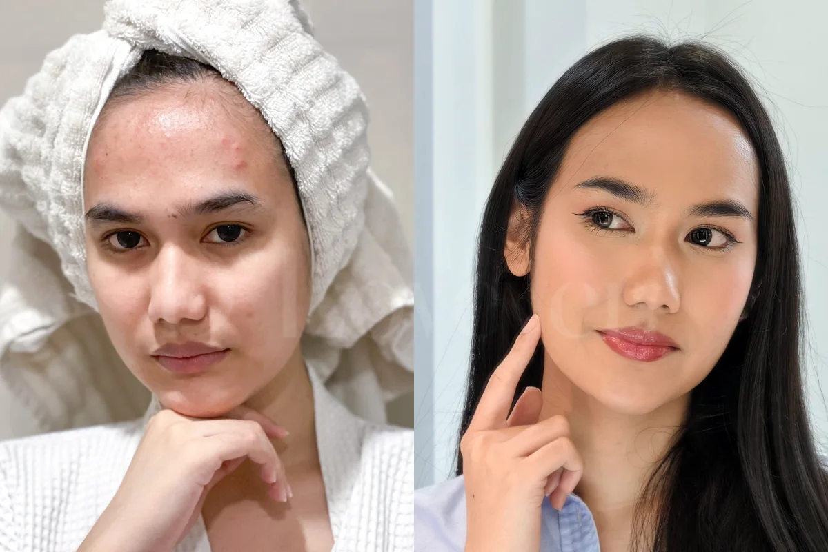 ทำ Pico Laser ครั้งแรกที่ Dlovevery Clinic รอยสิว แต่งหน้า กับไม่แต่งหน้า