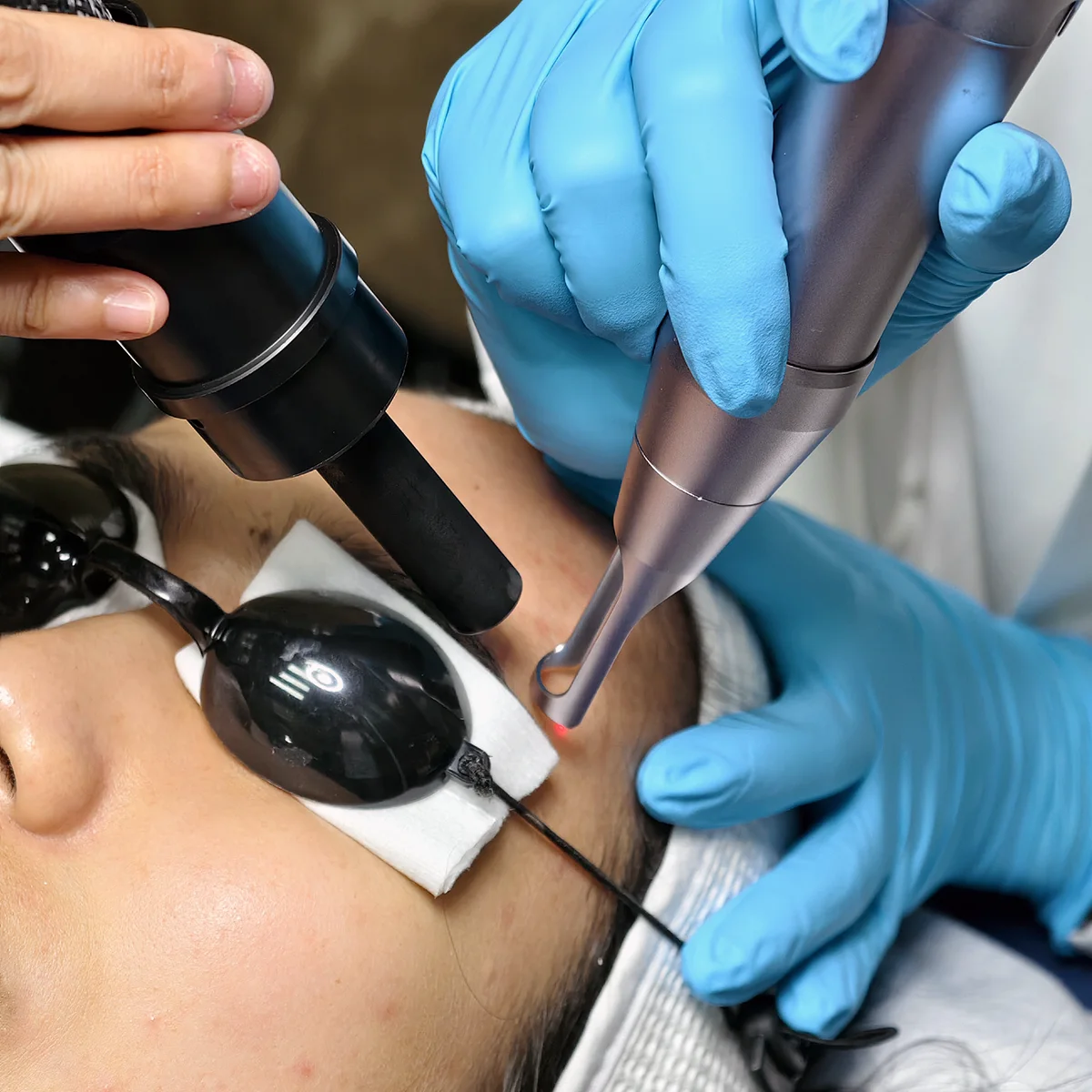 บอกลารอยสิว! แชร์ประสบการณ์ Pico Laser ที่ Dlovevery Clinic