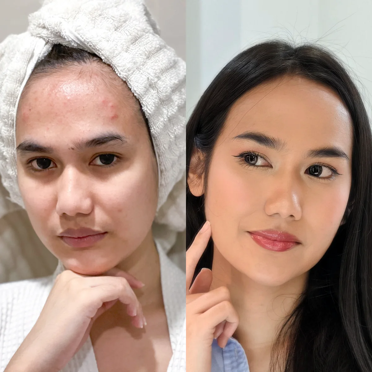 น้องยุรีทำ D’ Aura Bright ทุกอาทิตย์ ทำ Pico Laser ทุกเดือน รอยสิวก็จะจางลงแบบนี้แหล่ะ