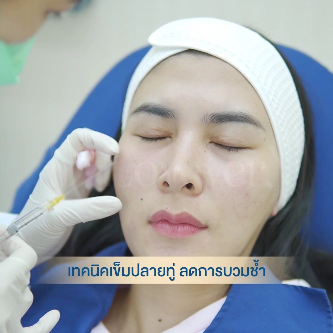 หมอต้าร์ฉีดฟิลเลอร์ [รีวิว] ฟิลเลอร์ใต้ตา ใกล้ CDC, รามคำแหง สวยปังจนเพื่อนทัก! ราคาเริ่มต้น 7999 บาท เห็นผลทันที